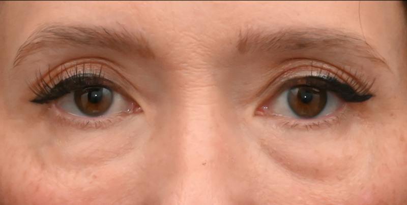 Lower Blepharoplasty Before & After Gallery - Patient 199738 - Image 3