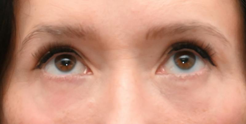 Lower Blepharoplasty Before & After Gallery - Patient 199738 - Image 6