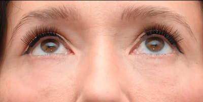 Lower Blepharoplasty Before & After Gallery - Patient 199738 - Image 2