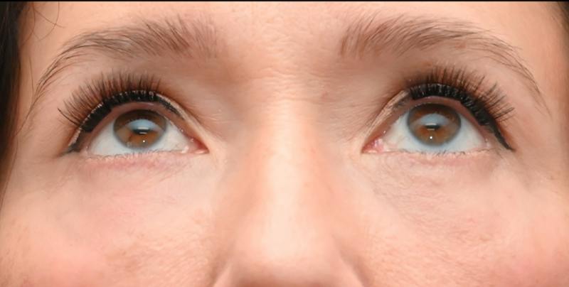 Lower Blepharoplasty Before & After Gallery - Patient 199738 - Image 2