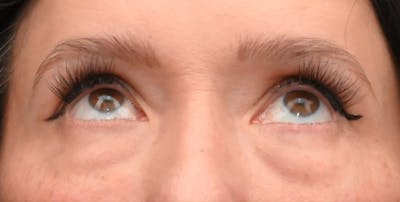 Lower Blepharoplasty Before & After Gallery - Patient 199738 - Image 1