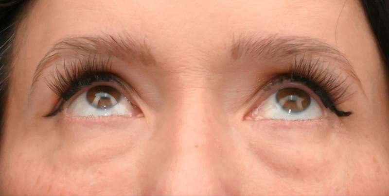 Lower Blepharoplasty Before & After Gallery - Patient 199738 - Image 1