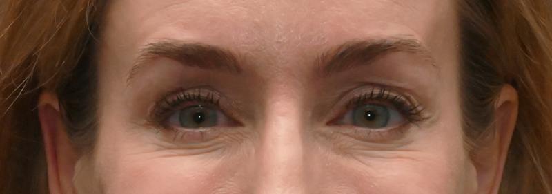 Brow Lift Before & After Gallery - Patient 555629 - Image 2