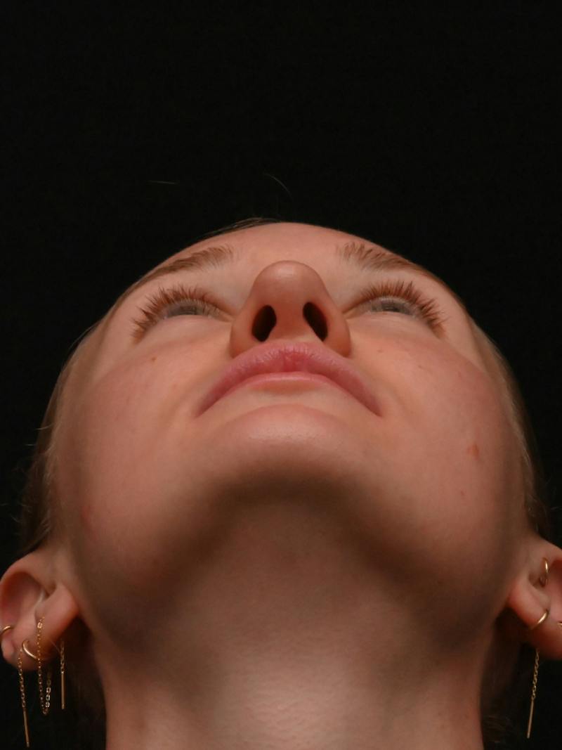 Rhinoplasty Before & After Gallery - Patient 326023 - Image 12