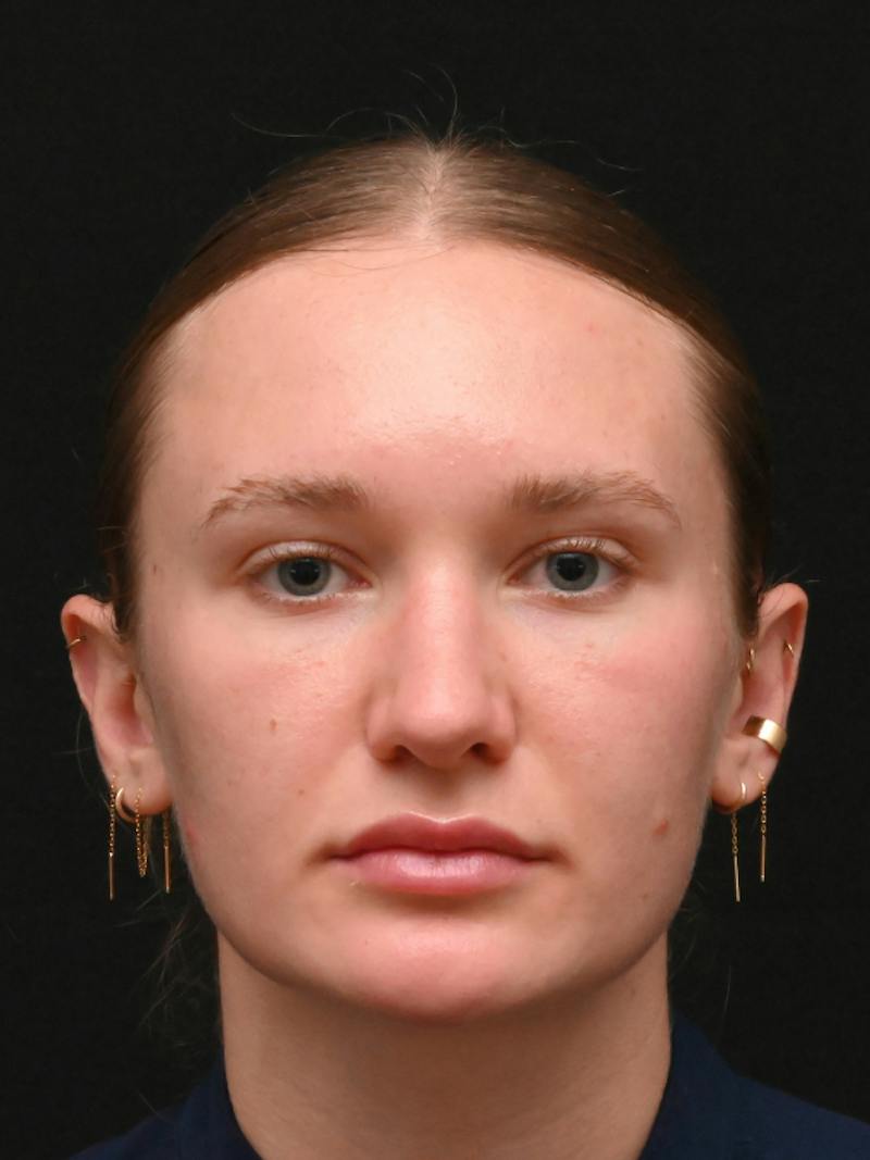 Rhinoplasty Before & After Gallery - Patient 326023 - Image 8