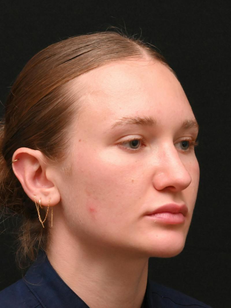 Rhinoplasty Before & After Gallery - Patient 326023 - Image 6