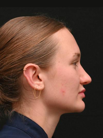 Rhinoplasty Before & After Gallery - Patient 326023 - Image 2