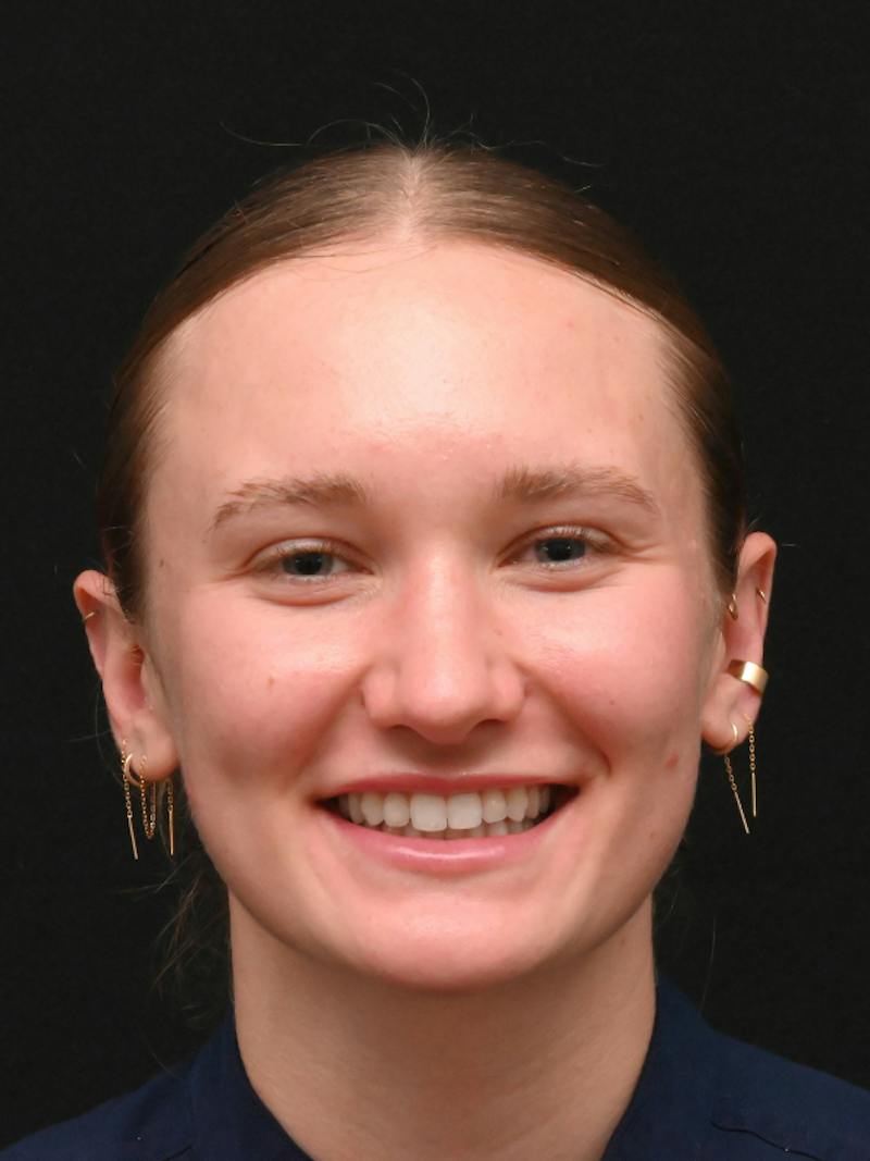 Rhinoplasty Before & After Gallery - Patient 326023 - Image 10