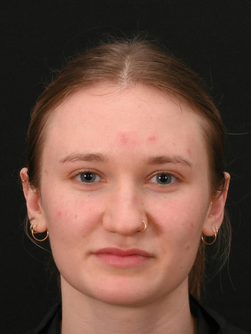 Rhinoplasty Before & After Gallery - Patient 326023 - Image 7