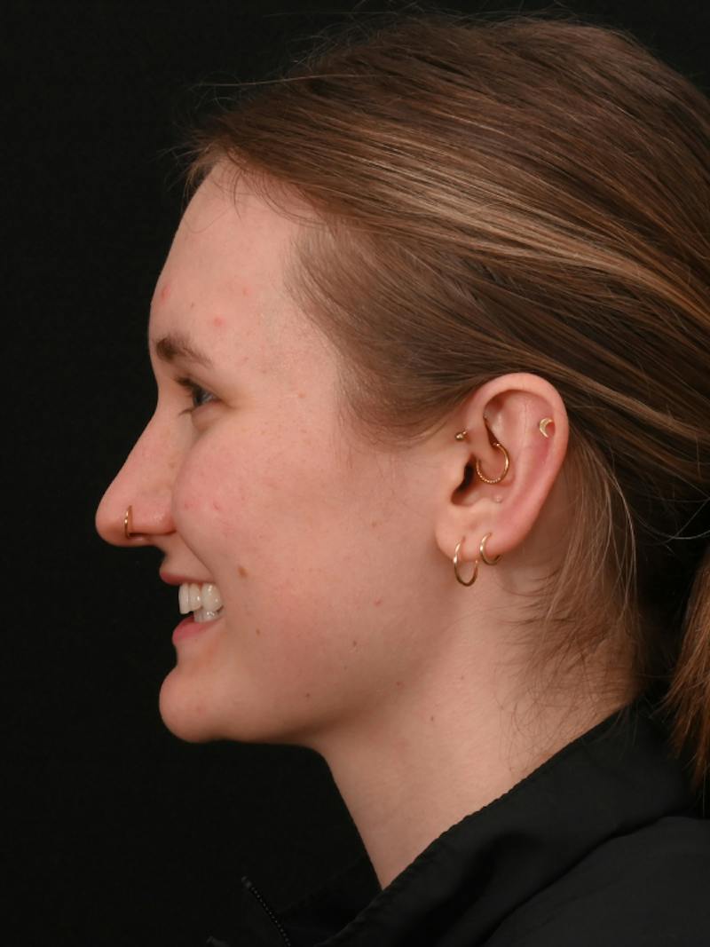Rhinoplasty Before & After Gallery - Patient 326023 - Image 17