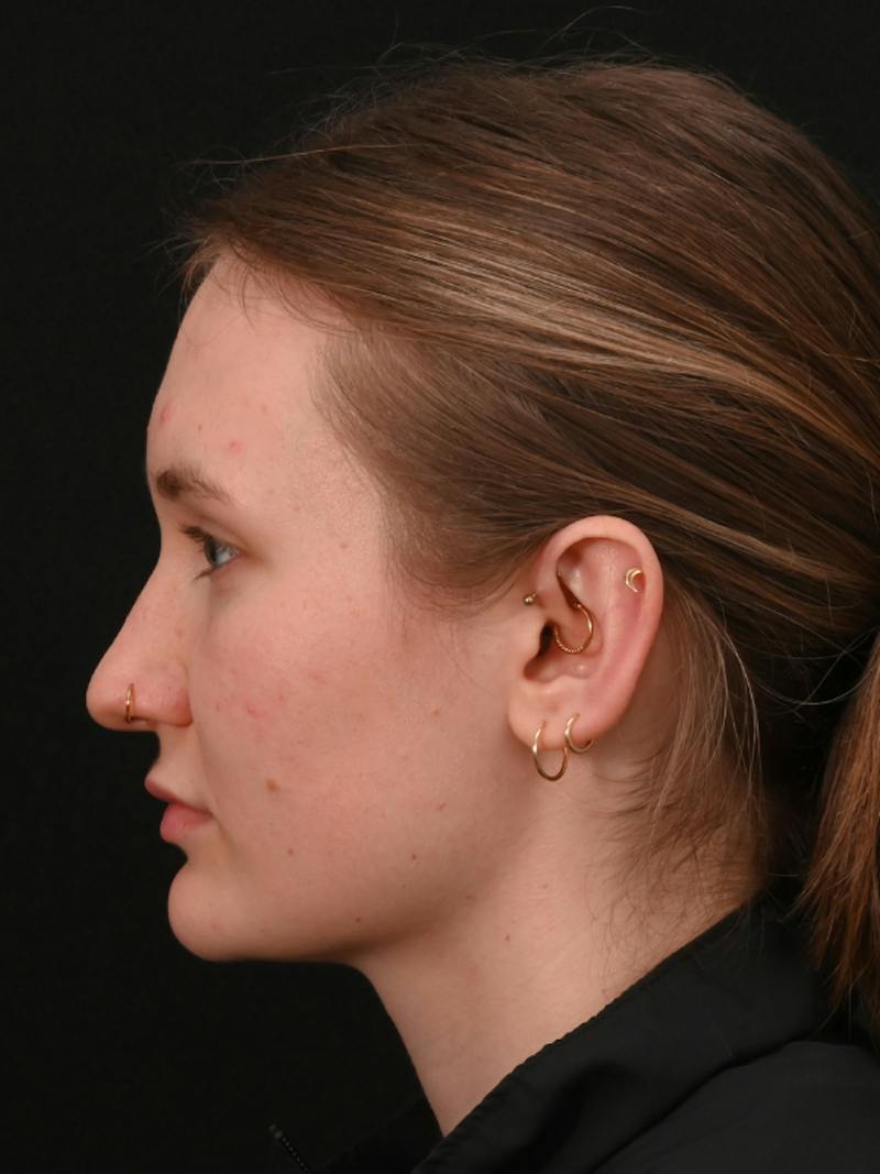 Rhinoplasty Before & After Gallery - Patient 326023 - Image 15