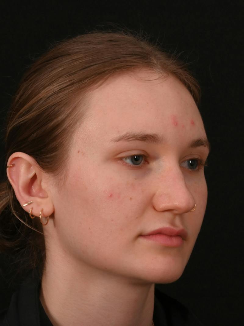 Rhinoplasty Before & After Gallery - Patient 326023 - Image 5