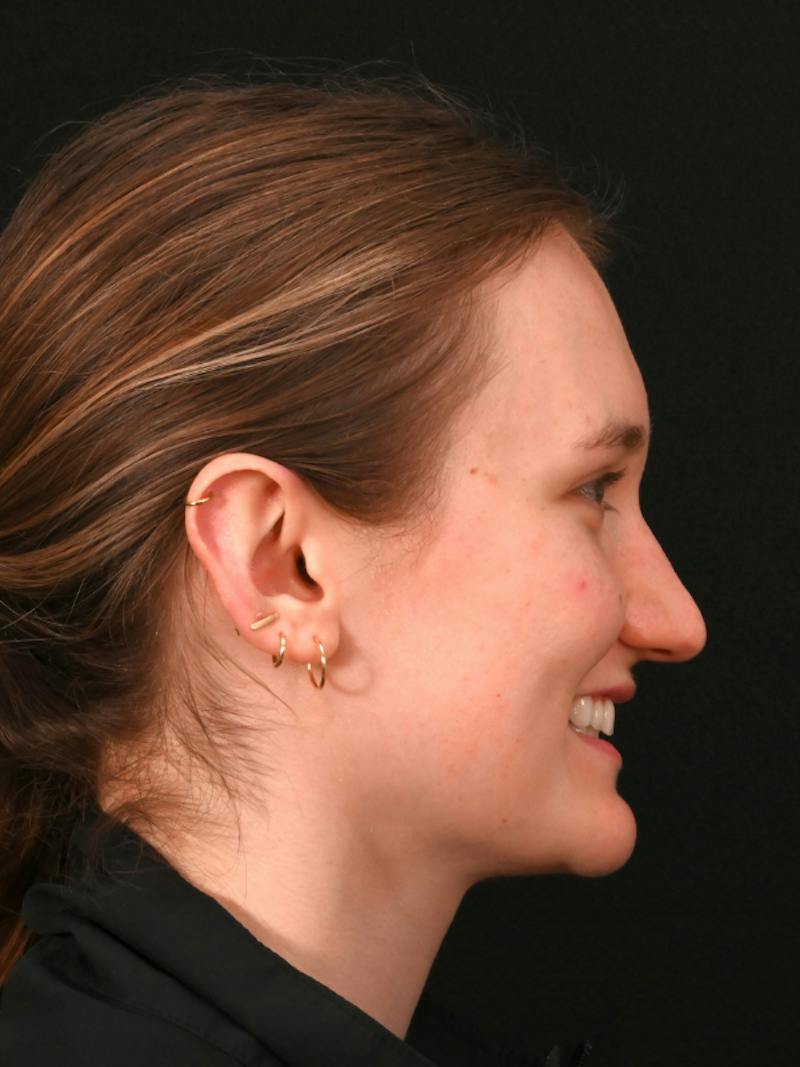 Rhinoplasty Before & After Gallery - Patient 326023 - Image 3