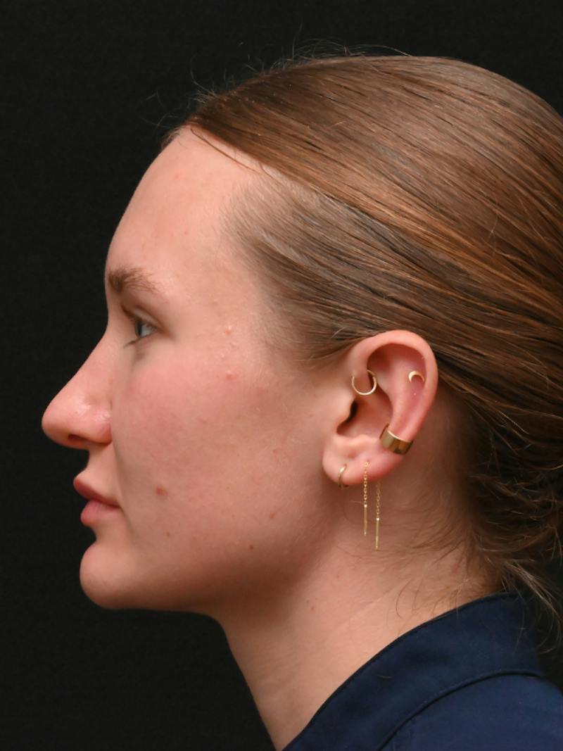 Rhinoplasty Before & After Gallery - Patient 326023 - Image 16
