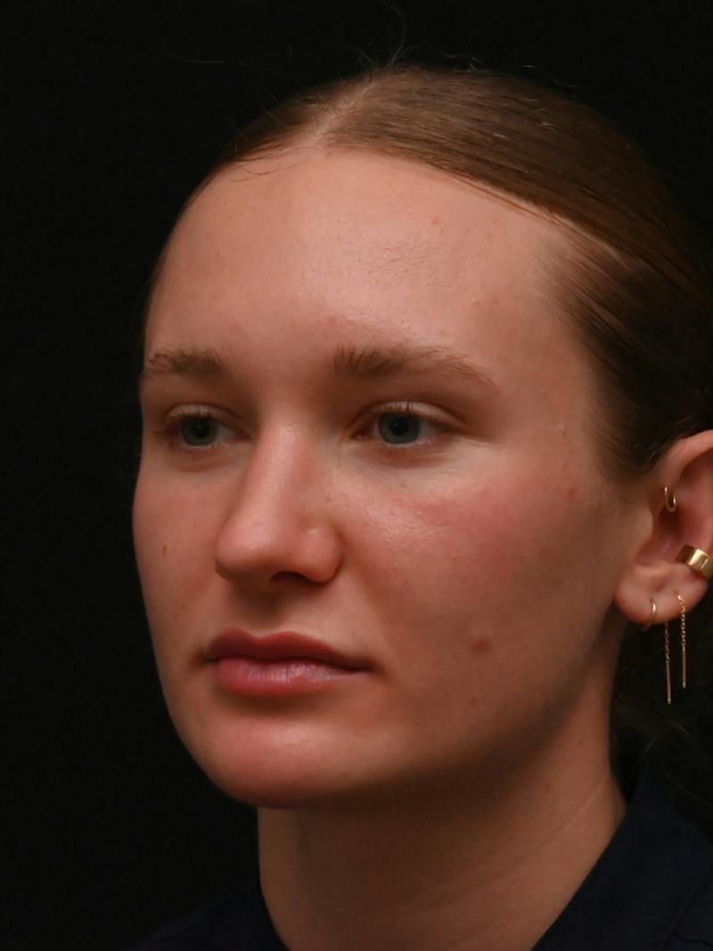 Rhinoplasty Before & After Gallery - Patient 326023 - Image 14