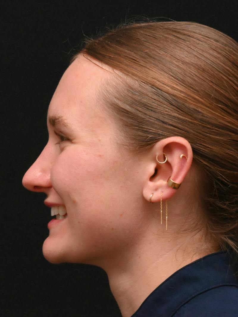 Rhinoplasty Before & After Gallery - Patient 326023 - Image 18