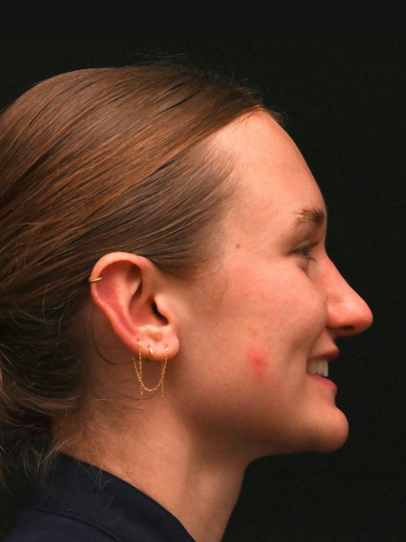 Rhinoplasty Before & After Gallery - Patient 326023 - Image 4