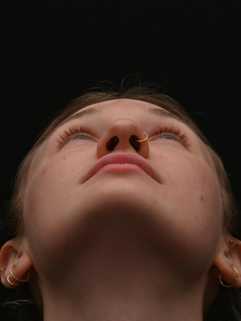 Rhinoplasty Before & After Gallery - Patient 326023 - Image 11