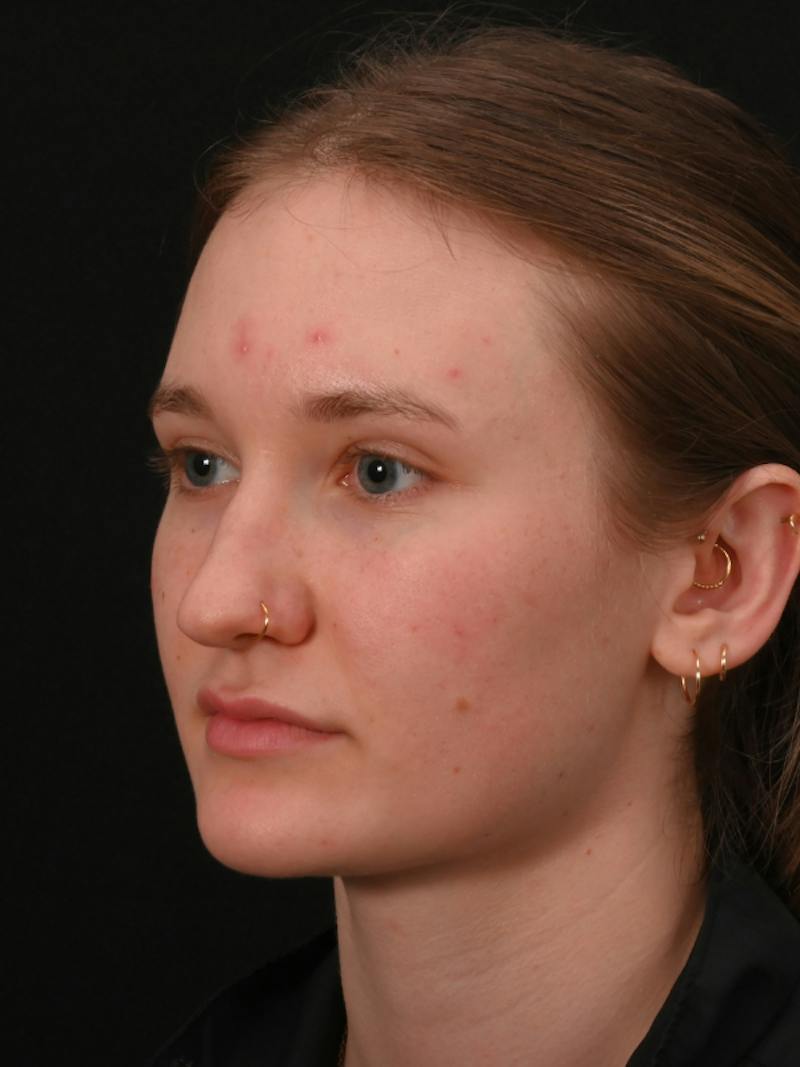 Rhinoplasty Before & After Gallery - Patient 326023 - Image 13