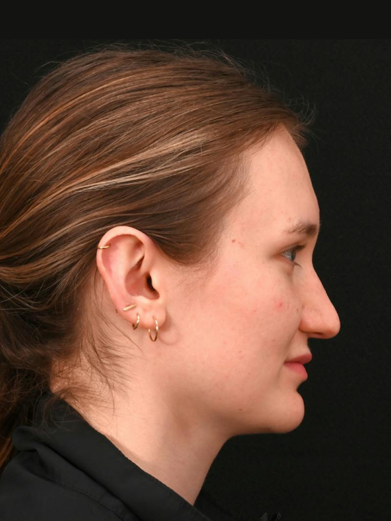 Rhinoplasty Before & After Gallery - Patient 326023 - Image 1