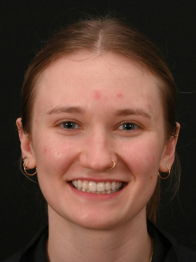 Rhinoplasty Before & After Gallery - Patient 326023 - Image 9