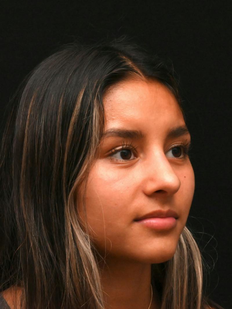 Rhinoplasty Before & After Gallery - Patient 145994 - Image 4