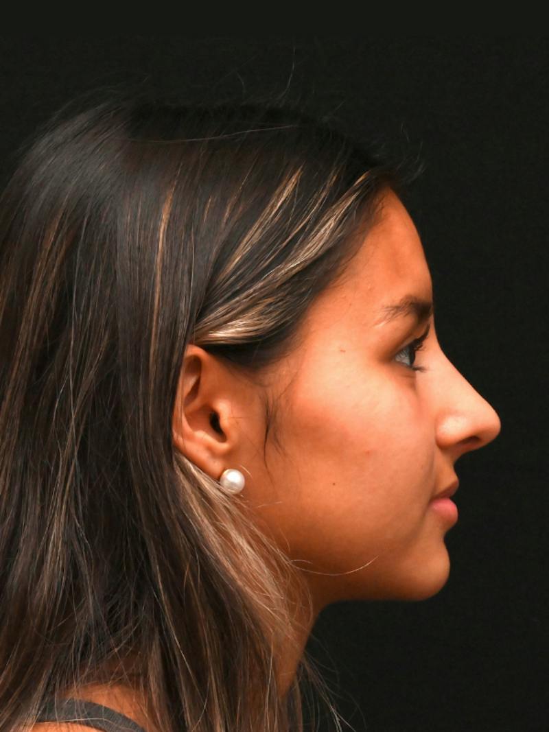 Rhinoplasty Before & After Gallery - Patient 145994 - Image 6