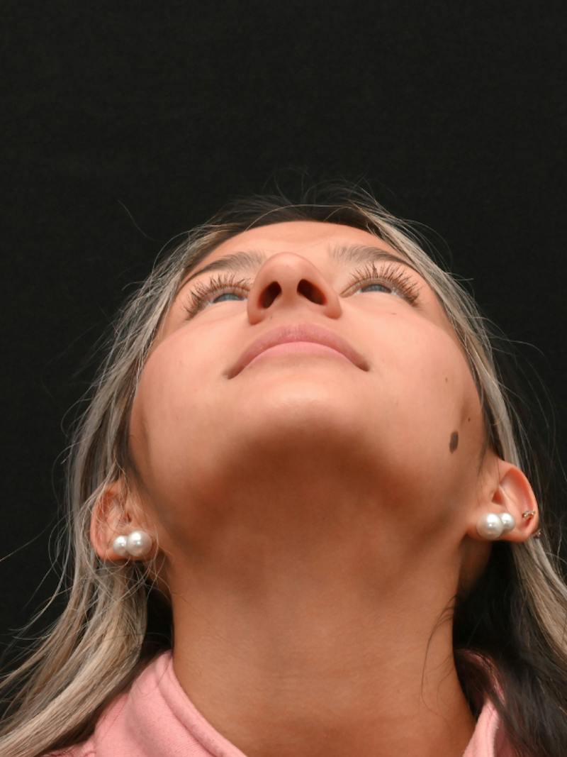 Rhinoplasty Before & After Gallery - Patient 145994 - Image 7