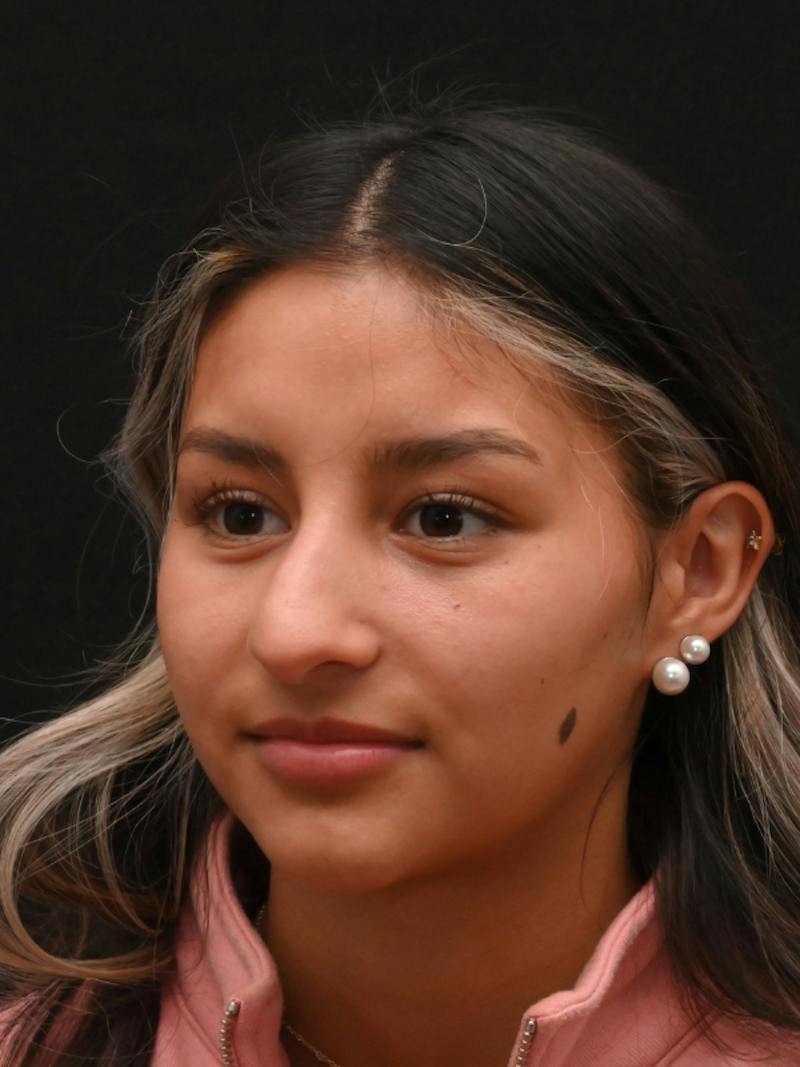 Rhinoplasty Before & After Gallery - Patient 145994 - Image 9