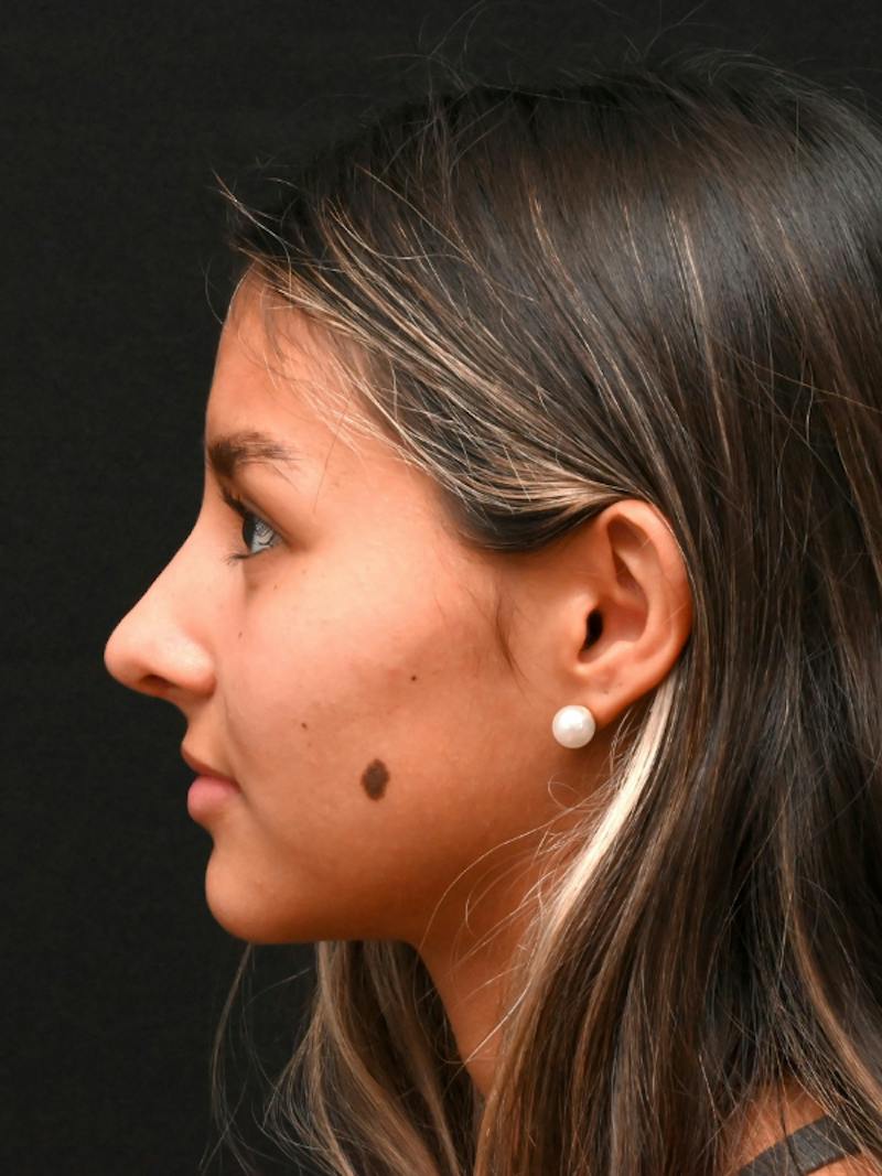 Rhinoplasty Before & After Gallery - Patient 145994 - Image 12
