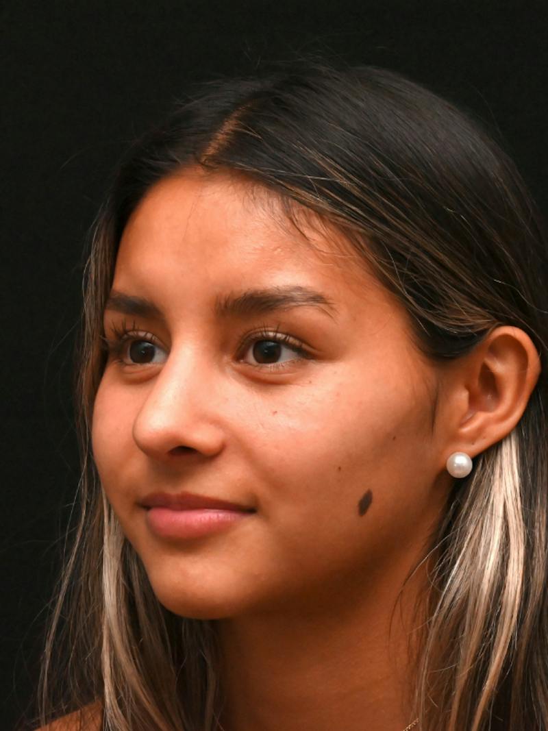 Rhinoplasty Before & After Gallery - Patient 145994 - Image 10