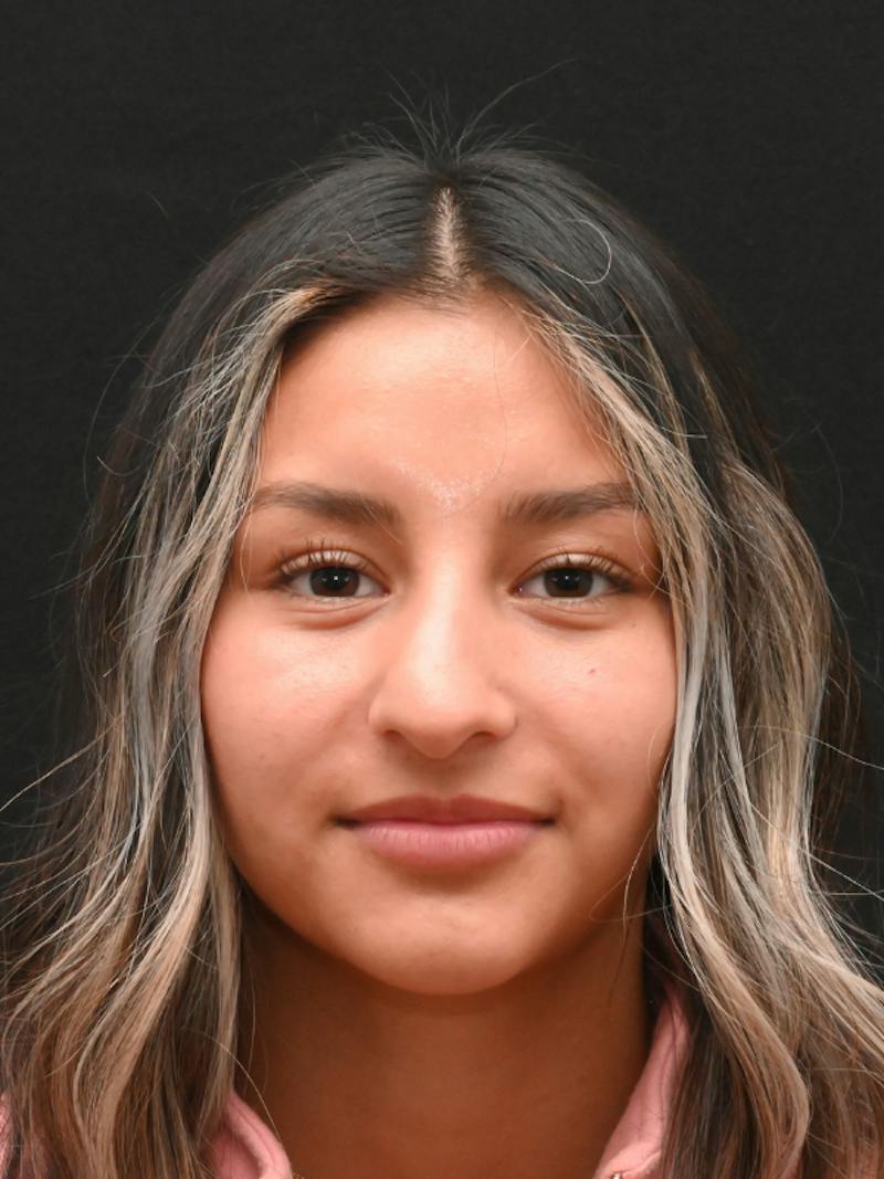 Rhinoplasty Before & After Gallery - Patient 145994 - Image 1