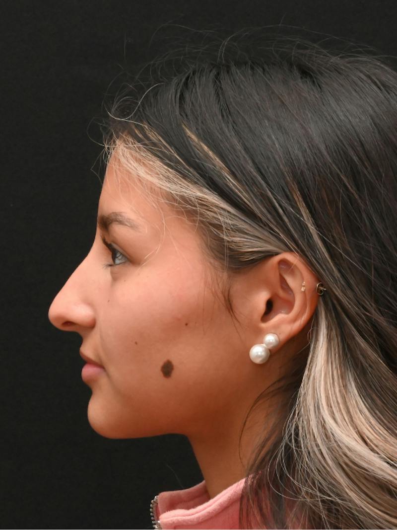 Rhinoplasty Before & After Gallery - Patient 145994 - Image 11