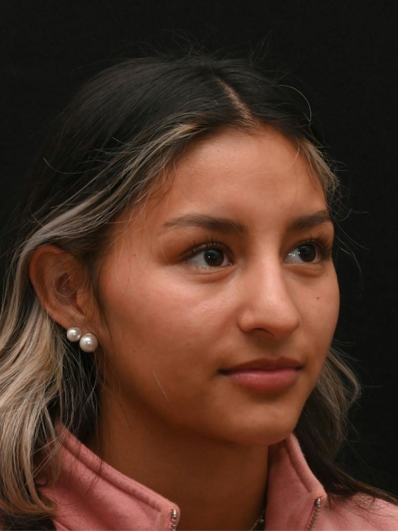 Rhinoplasty Before & After Gallery - Patient 145994 - Image 3