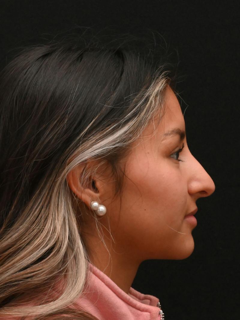 Rhinoplasty Before & After Gallery - Patient 145994 - Image 5