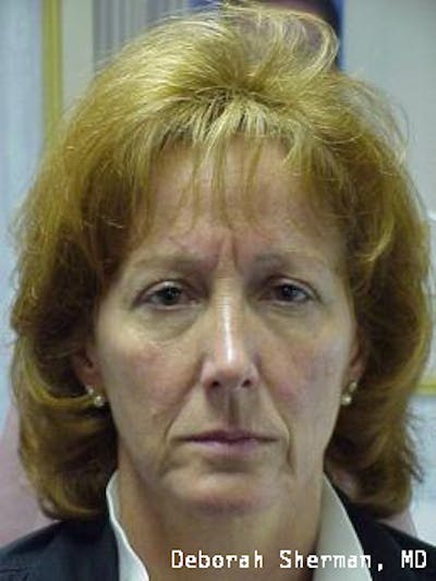 Endoscopic Brow Lift Before & After Gallery - Patient 173876 - Image 1