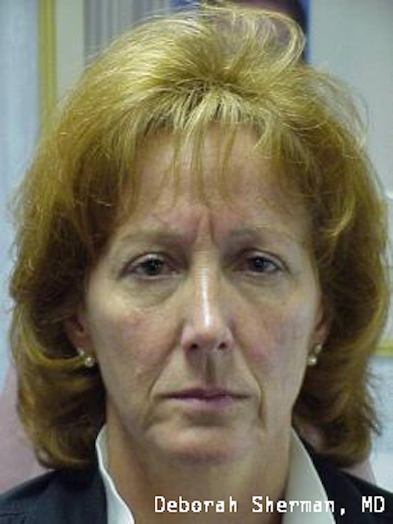 Endoscopic Brow Lift Before & After Gallery - Patient 173876 - Image 1