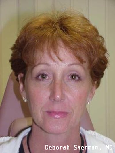 Endoscopic Brow Lift Before & After Gallery - Patient 173876 - Image 2