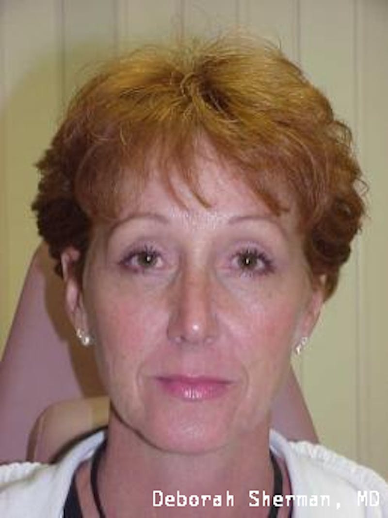 Endoscopic Brow Lift Before & After Gallery - Patient 173876 - Image 2