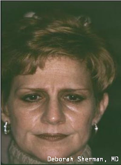 Endoscopic Brow Lift Before & After Gallery - Patient 151919 - Image 1