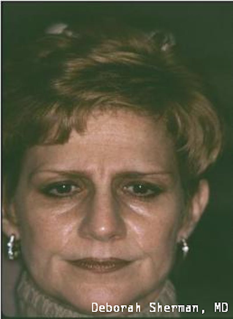 Endoscopic Brow Lift Before & After Gallery - Patient 151919 - Image 1