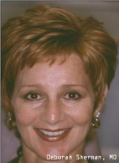 Endoscopic Brow Lift Before & After Gallery - Patient 151919 - Image 2