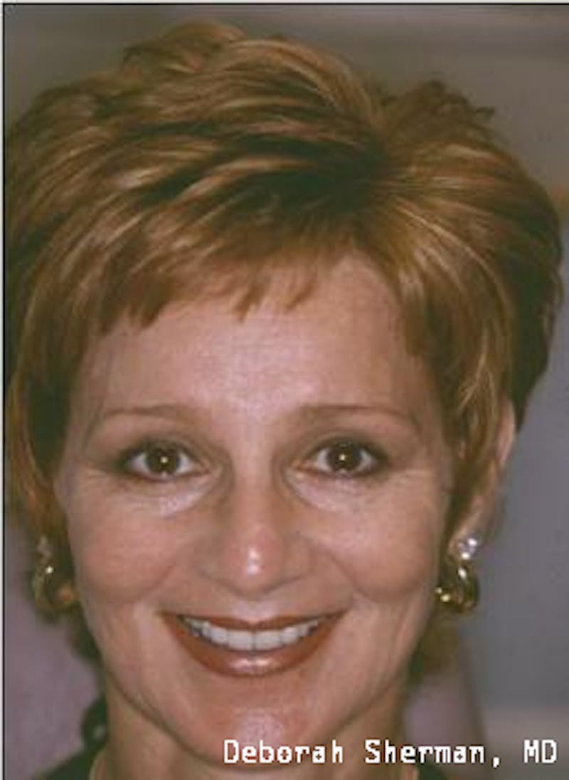 Endoscopic Brow Lift Before & After Gallery - Patient 151919 - Image 2