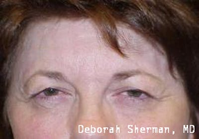Endoscopic Brow Lift Before & After Gallery - Patient 378747 - Image 1