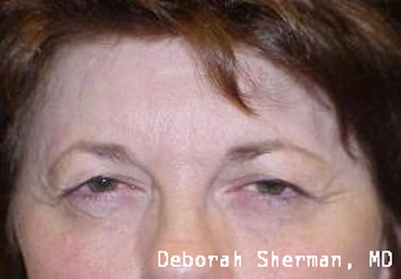 Endoscopic Brow Lift Before & After Gallery - Patient 378747 - Image 1