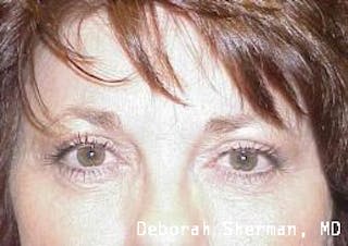 Endoscopic Brow Lift Before & After Gallery - Patient 378747 - Image 2