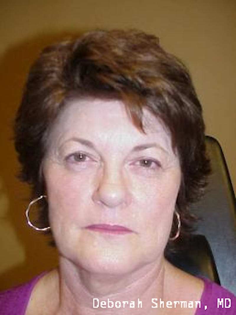 Endoscopic Brow Lift Before & After Gallery - Patient 378747 - Image 3