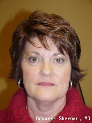 Endoscopic Brow Lift Before & After Gallery - Patient 378747 - Image 4