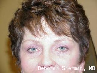 Endoscopic Brow Lift Before & After Gallery - Patient 201712 - Image 2