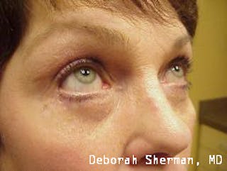 Endoscopic Brow Lift Before & After Gallery - Patient 201712 - Image 4